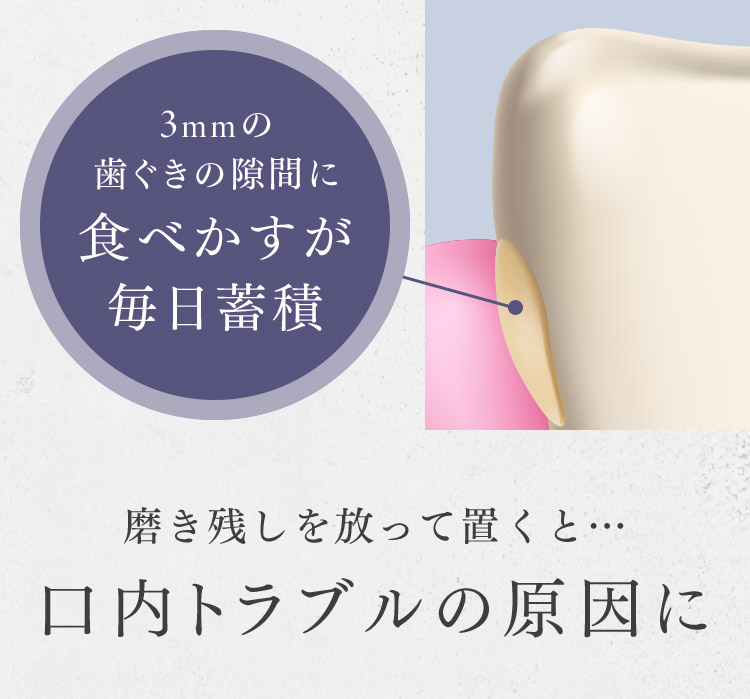 磨き残しを放って置くと…口内トラブルの原因に