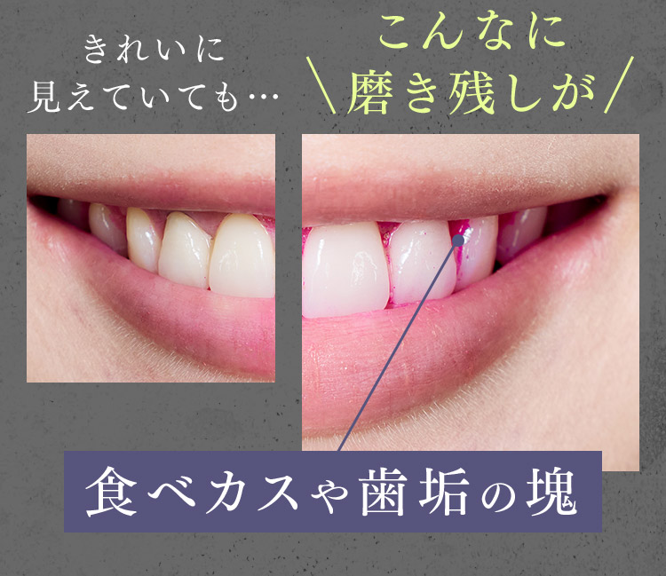 食べカスや歯垢の塊