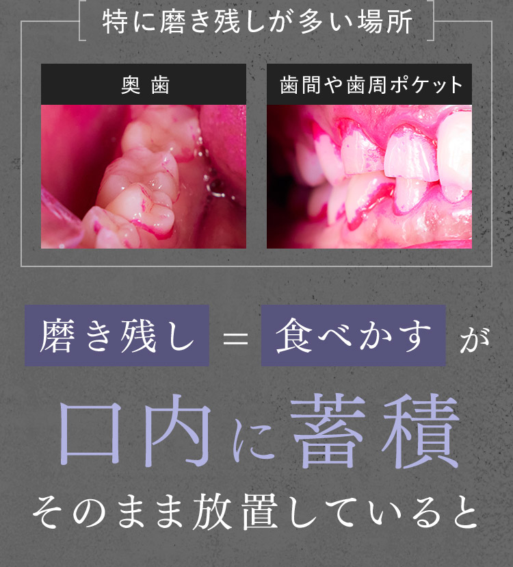 磨き残し=食べかすが口内に蓄積 そのまま放置していると