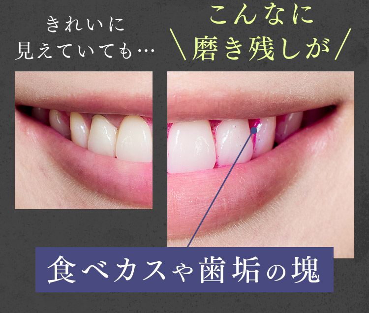食べカスや歯垢の塊