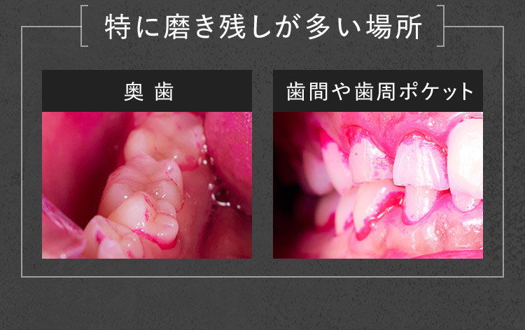 特に磨き残しが多い場所 奥歯 歯間や歯周ポケット