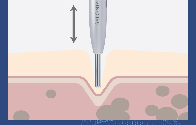 肌の深部にアプローチする美容機器の作用を示す断面図