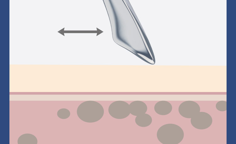 カッサを肌表面に沿わせて動かす使用方法の図解
